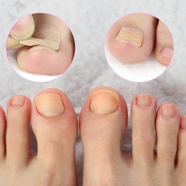 Kit with 100 Stickers for Ingrown Toenails