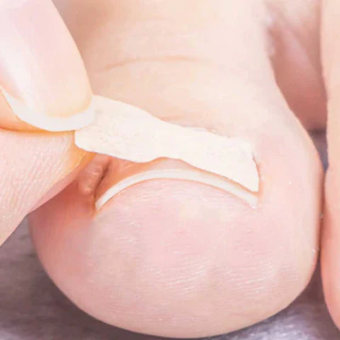 Kit with 100 Stickers for Ingrown Toenails