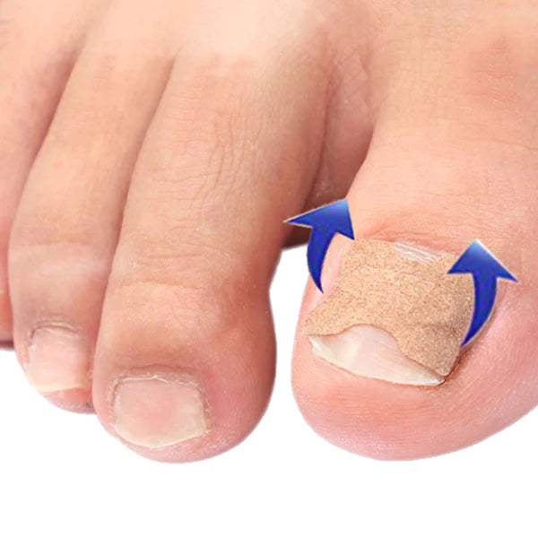 Kit with 100 Stickers for Ingrown Toenails